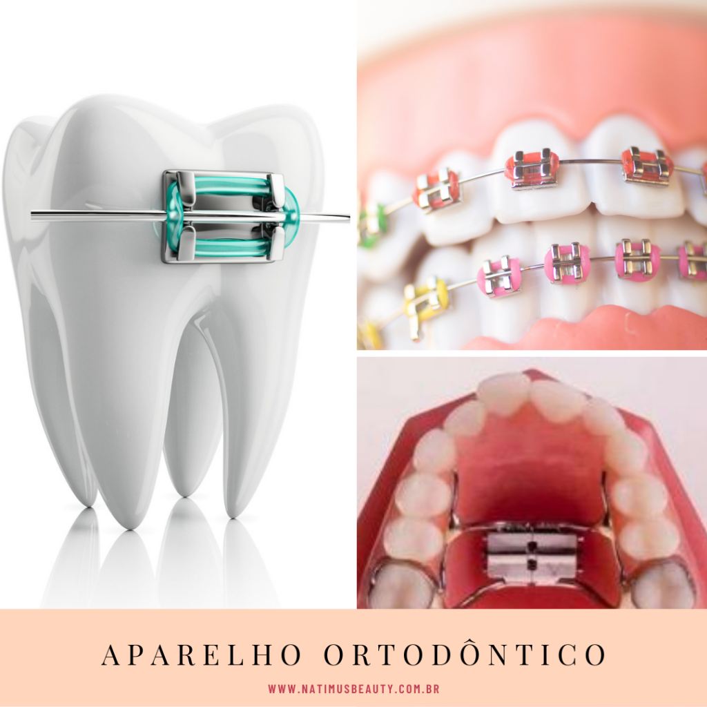 Cada modelo de aparelho ortodôntico foi desenvolvido para um tratamento específico, por isso, faz-se necessário apoio de um profissional da odontologia para escolha correta. Natimus Beauty Blog.