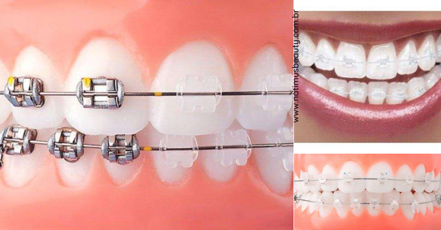 O uso de aparelhos transparentes está cada vez mais comum. Corrigir problemas dentários sem abalar, ainda que provisoriamente, a estética é um dos motivos pelo qual esse dispositivo é tão requisitado.